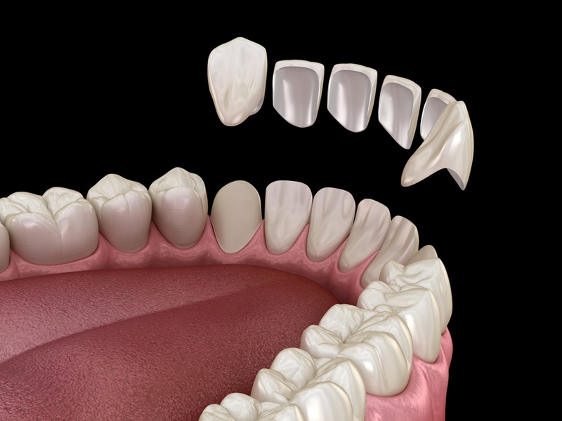 porcelain veneers